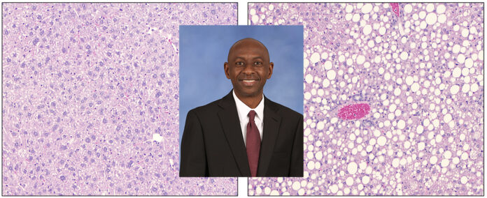 UAH fatty liver with Dr Lawan